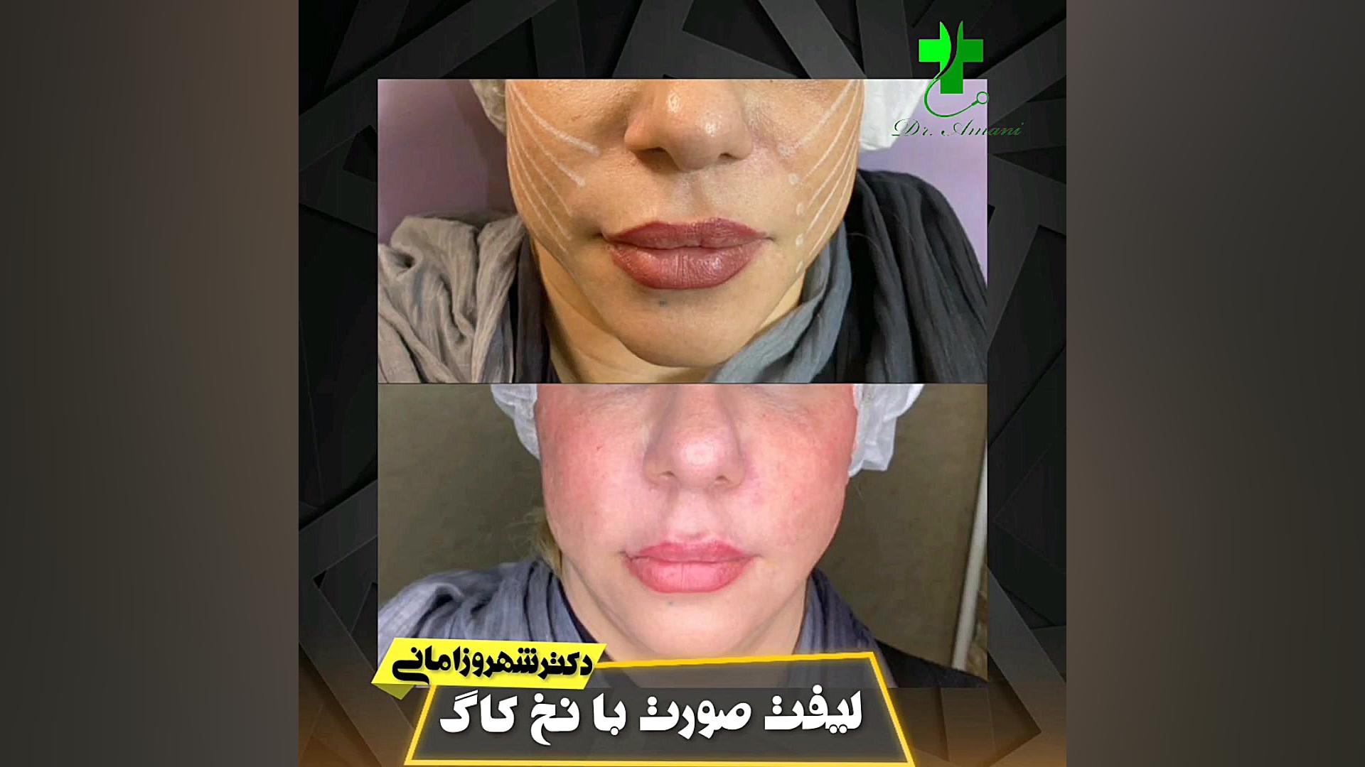 لیفت صورت با نخ کاگ اینسایزینگ