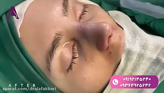 فیلم عمل زیبایی بینی در اتاق عمل پالبوسیکلیب