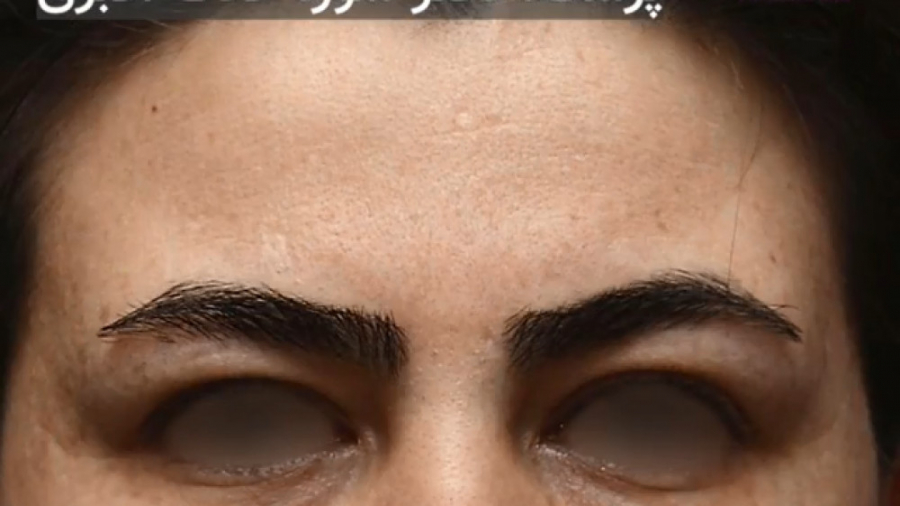 فیلم لیفت اندوسکوپیک پیشانی و ابرو میکرونیدلینگ