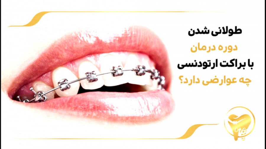 طولانی شدن دوره درمان با براکت ارتودنسی چه عوارضی دارد؟ کلینیک دندانپزشکی دکتر عزیز گشاده رو