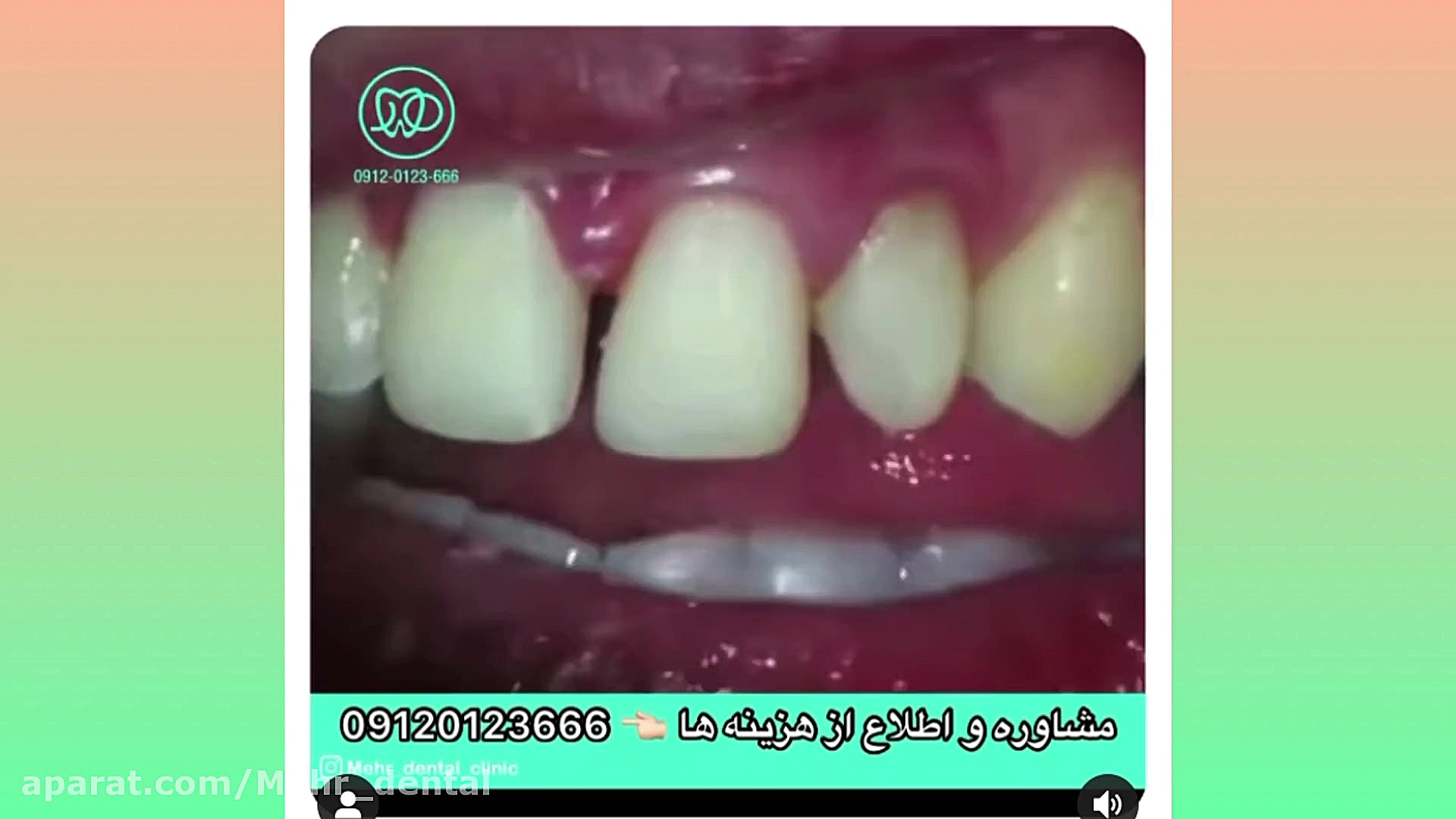 کلینیک دندانپزشکی مهر (ریموو کامپوزیت های قدیمی و اصلاح طرح لبخند با لمینت ) فورنزیک ژنتیک