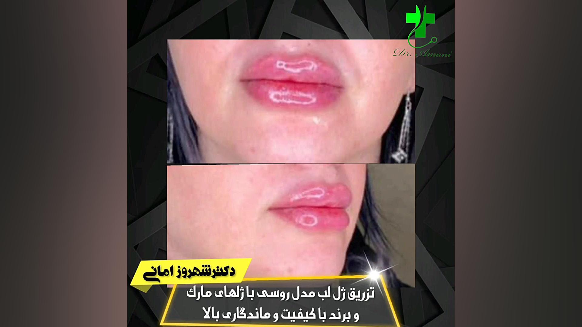 تزریق ژل لب مدل روسی با ژلهای مارک و برند با کیفیت و ماندگاری بالا اکستنشن تاج دندان