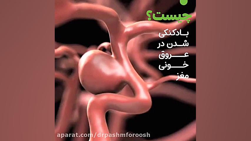 انوریسم مغزی کلینیک پوست
