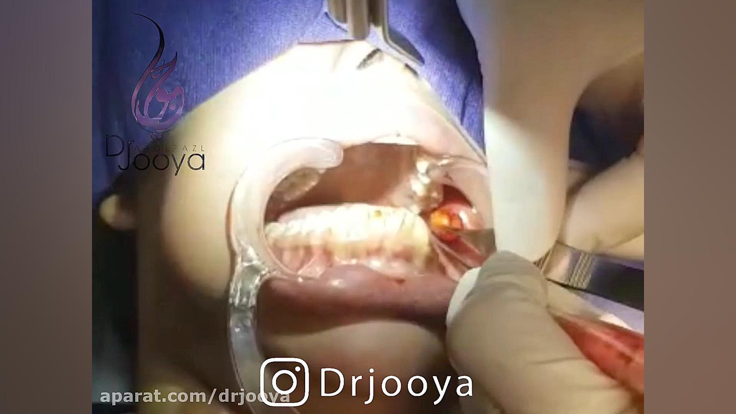 نمونه جراحی بوکال فت دکتر جویا متخصص پوست اصفهان دکتر ابوالفضل جویا