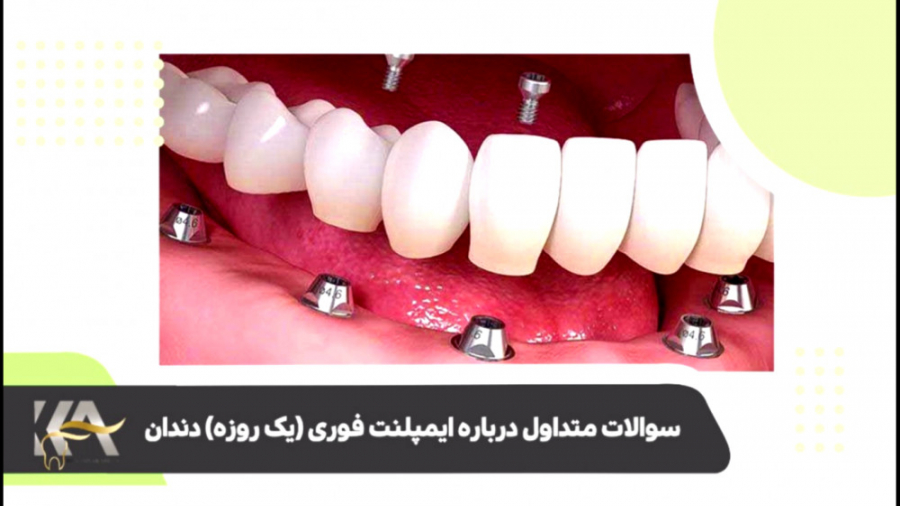 سوالات متداول درباره ایمپلنت فوری دکتر کامیار عباسی