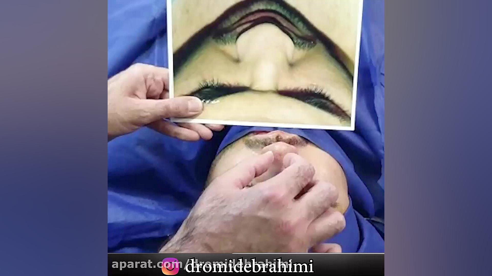 عمل زیبایی بینی توسط بهترین جراح بینی در تهران دکتر امید ابراهیمی دکتر امید ابراهیمی