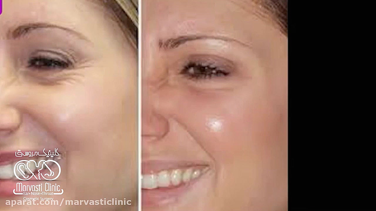 تزریق بوتاکس و جوانسازی صورت DLCO