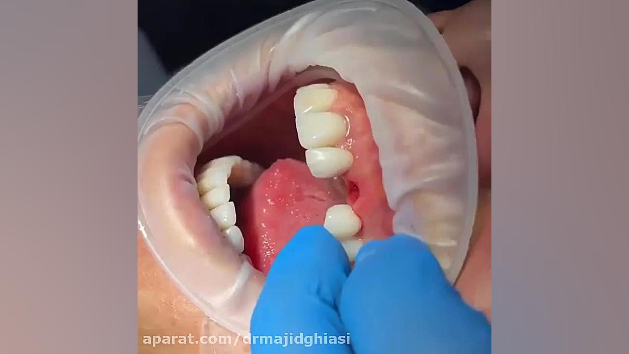 ایمپلنت دندان زیبایی دکترمجیدقیاسی