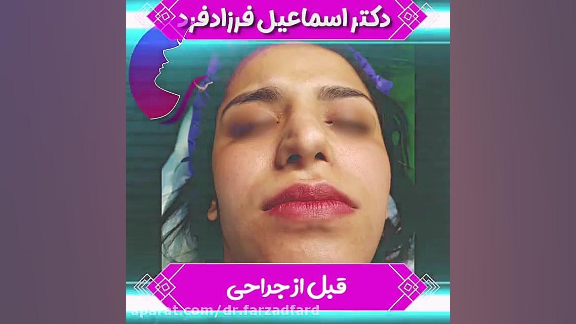 جراحی زیبایی بینی ثانویه دکتر اسماعیل فرزاد فرد - فوق تخصص پلاستیک