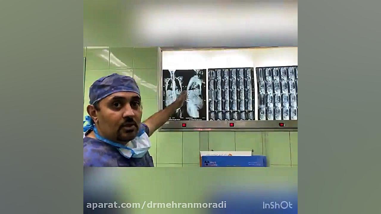 جراحی اختلال بالانس ساژیتال ستون فقرات و خروج پیچ های کمری به دلیل پوکی استخوان پروتز دندان