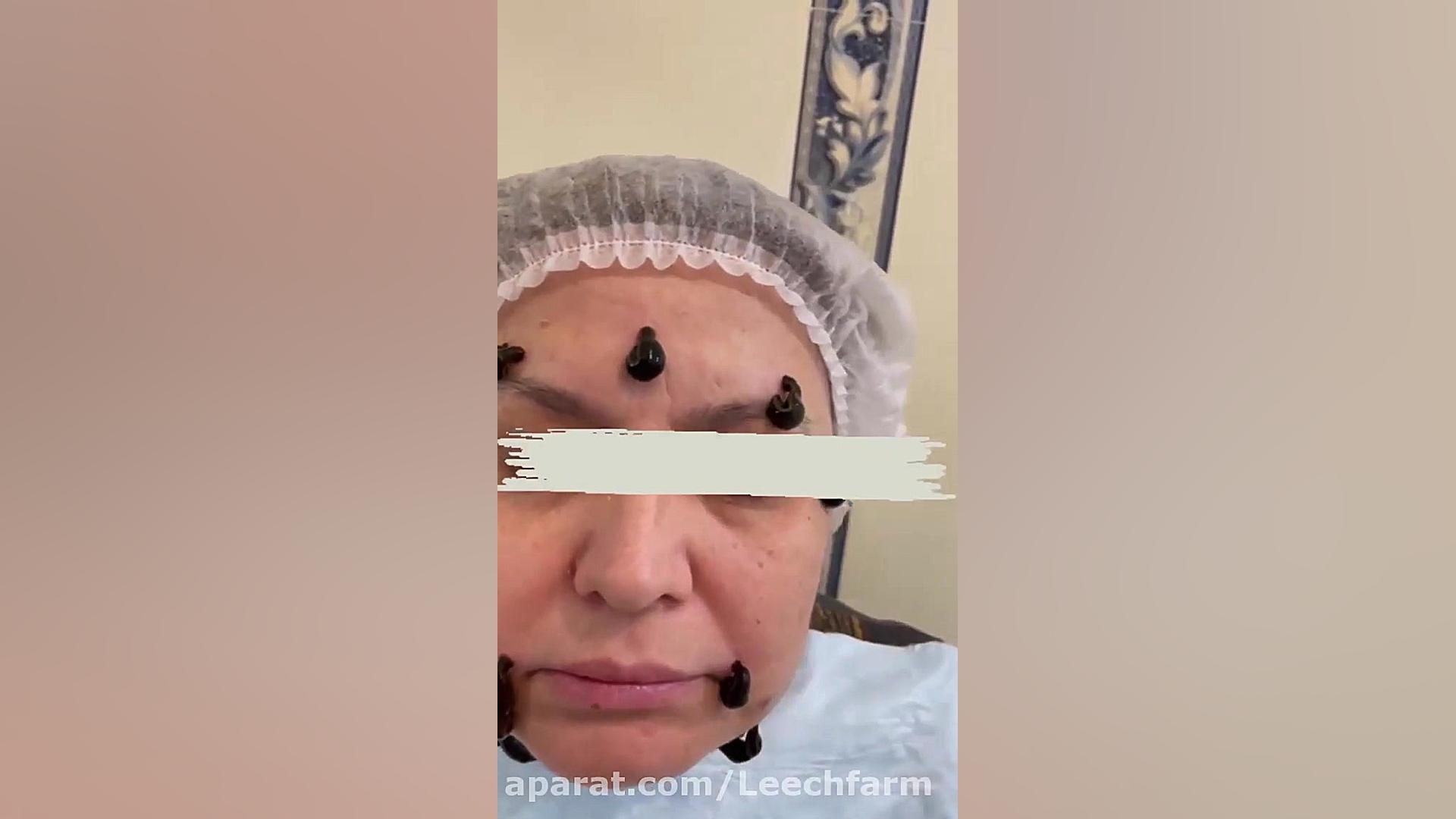زالو درمانی جهت رفع چین و چروک و شفافیت پوست صورت تست تحریک ACTH
