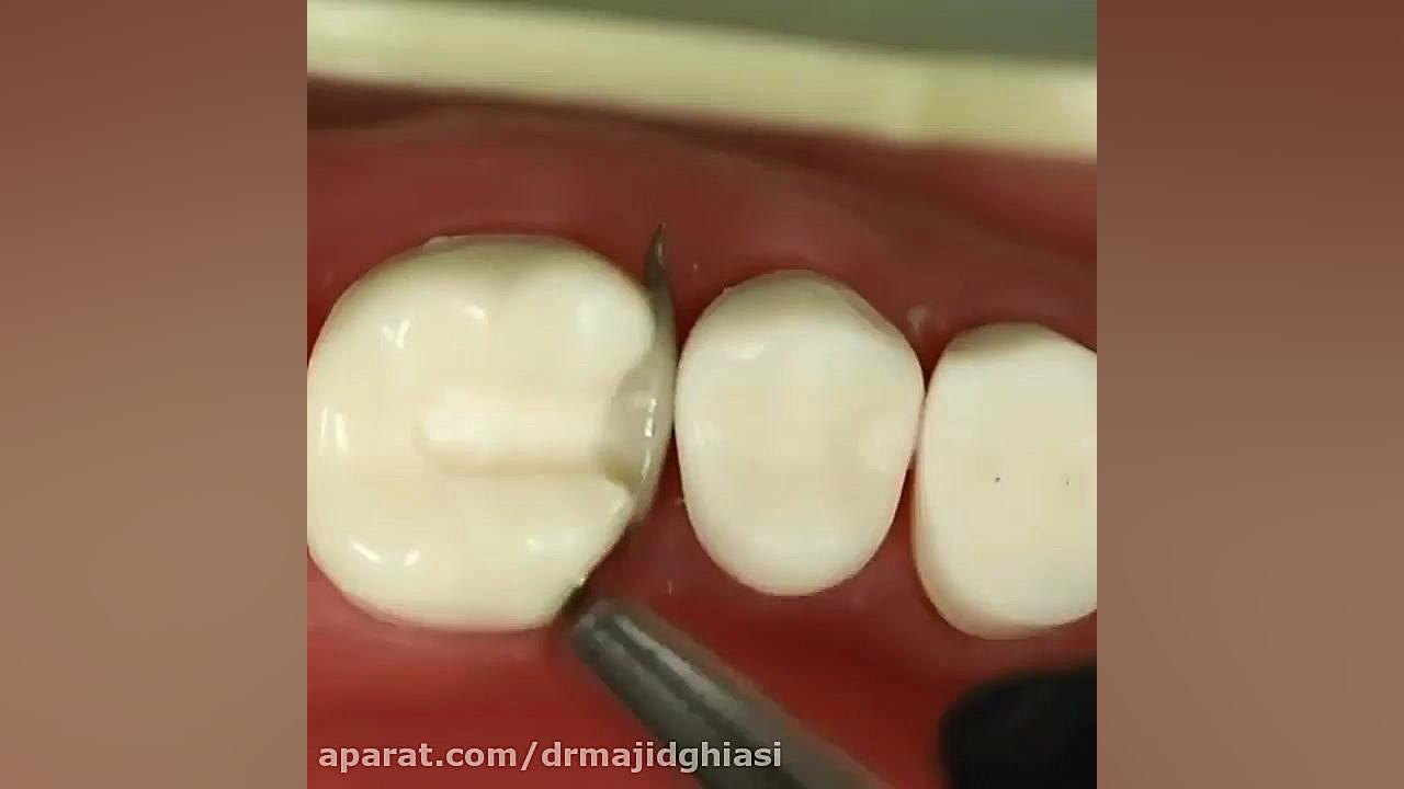 ترمیم شکستگی دندان دکترمجیدقیاسی