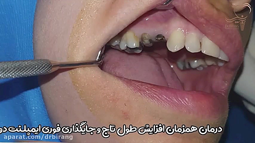 فیلم درمان همزمان افزایش طول تاج و جایگذاری فوری ایمپلنت دو دندان کنار هم. دکتر احسان بیرنگ
