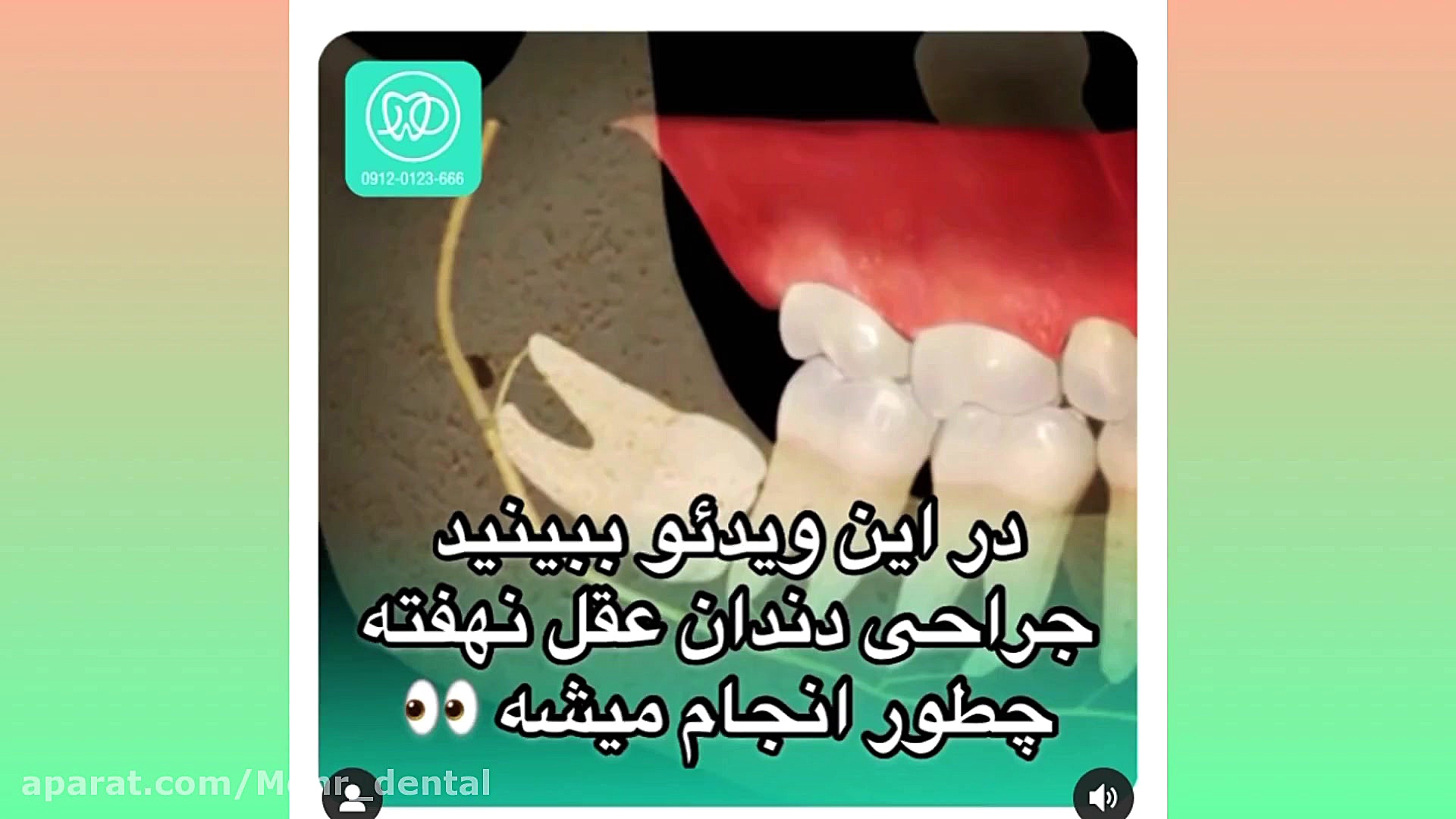 کلینیک دندانپزشکی مهر (mehr_dental_clinic) جراحی دندان عقل نهفته ترمیم سوختگی