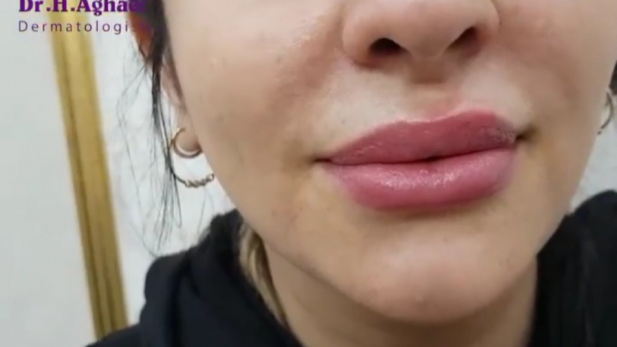 تزریق ژل لب نچرال و طبیعی دکتر حمیده آقایی