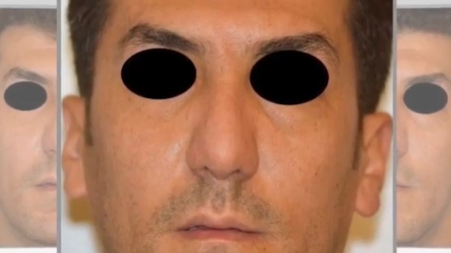 عمل بینی مردانه دکتر حمید رضا فتحی فوق تخصص جراحی پلاستیک