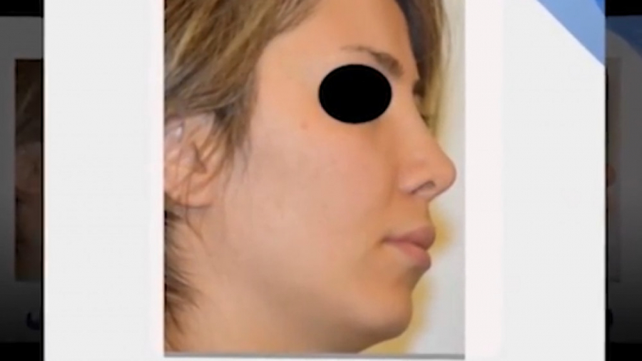 فیلم واقعی عمل بینی دکتر حمید رضا فتحی فوق تخصص جراحی پلاستیک