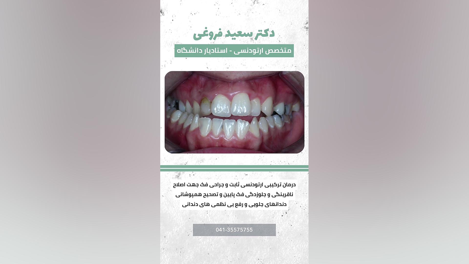 درمان ترکیبی ارتودنسی ثابت دکتر سعید فروغی متخصص ارتودنسی
