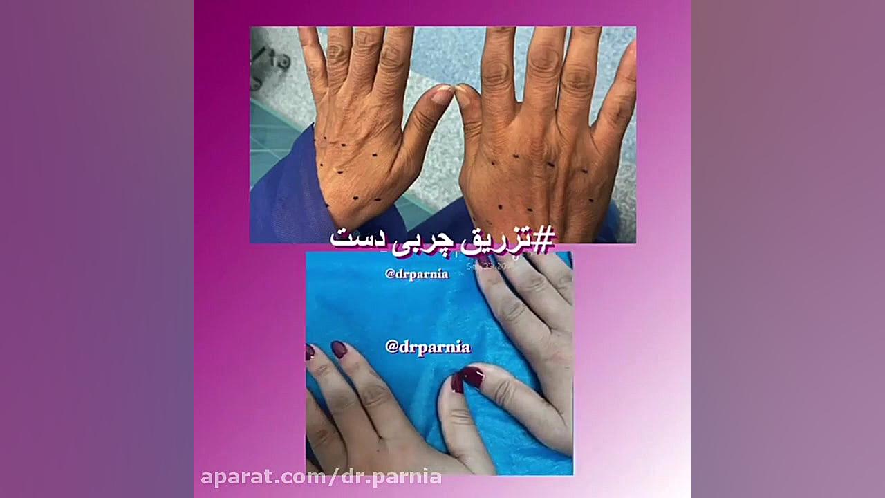 تزریق چربی دست دکتر رفیع پرنیا فوق تخصص پلاستیک