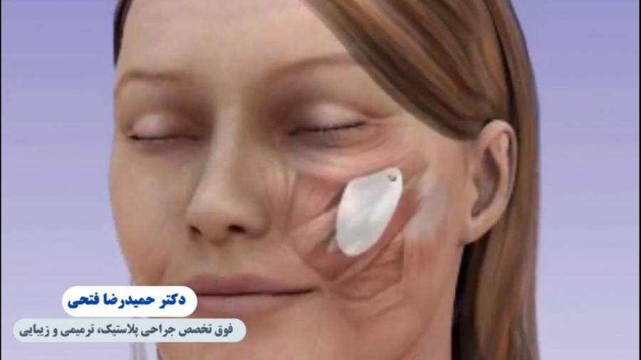 جای بخیه بعد از جراحی دکتر حمید رضا فتحی فوق تخصص جراحی پلاستیک
