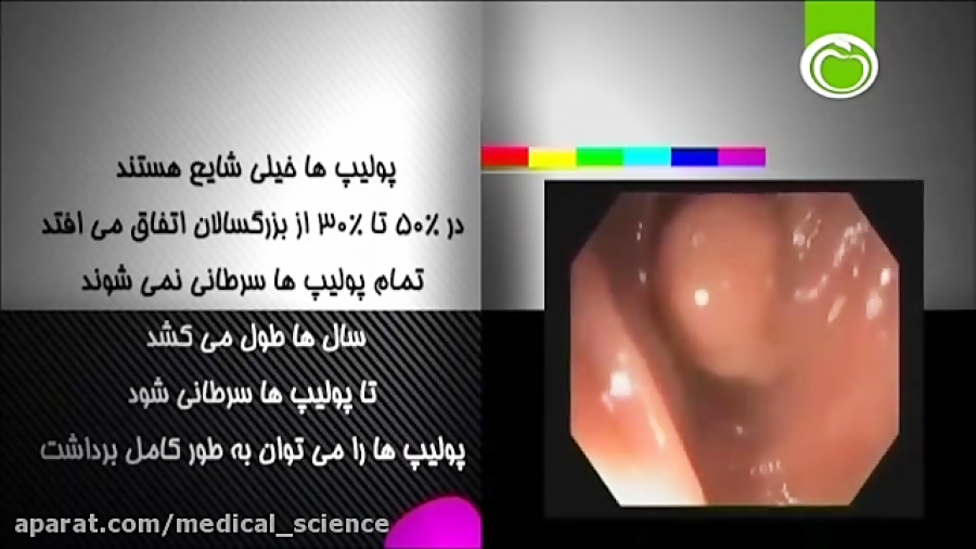 ارتباط پولیپ با سرطان روده چیست؟ اکستنشن تاج دندان