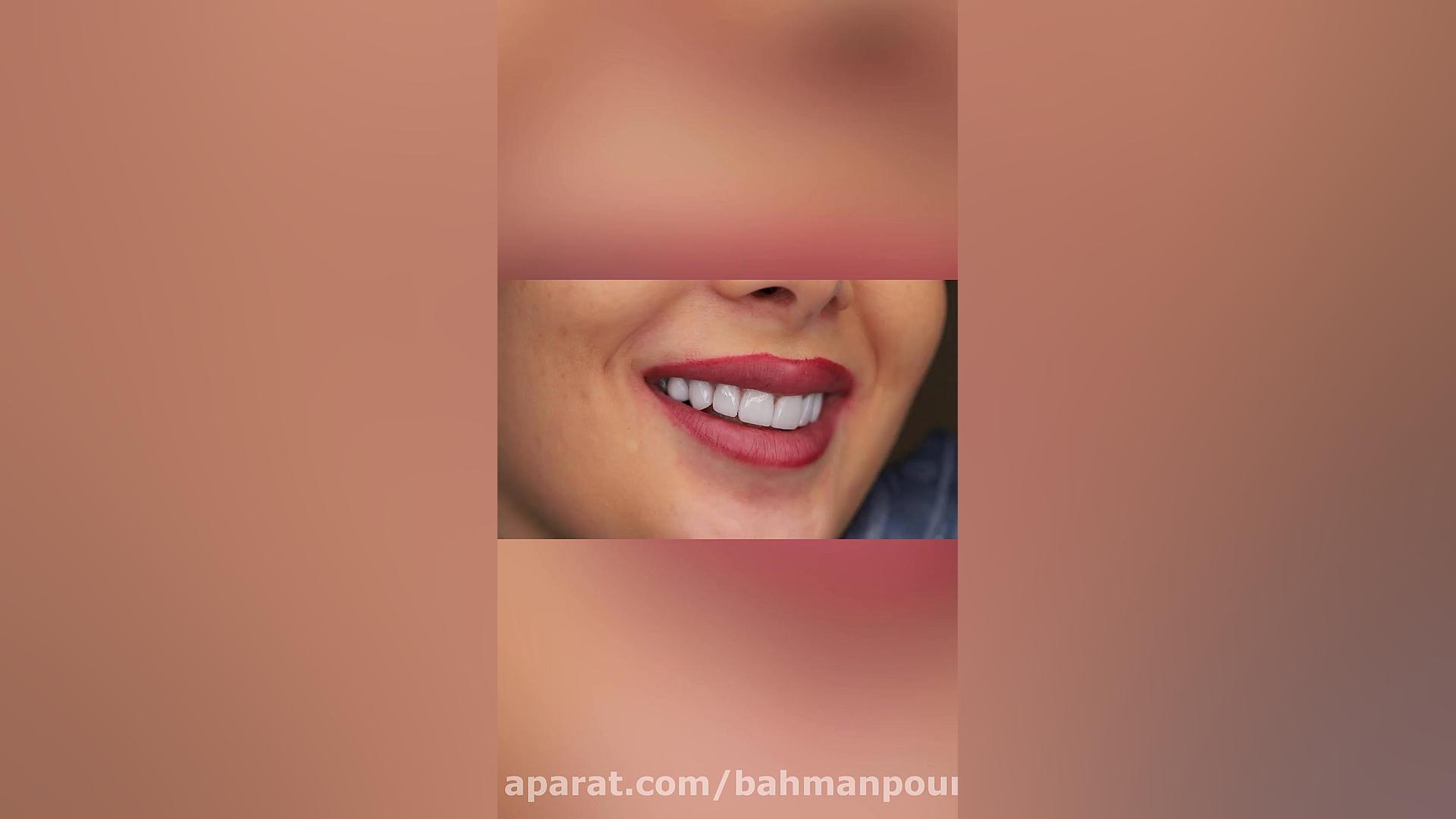 بهترین روکش دندان و لمینت سرامیکی (دکتر بهمن پوراقدم)02122220000 دکتر بهمن پوراقدم 02122220000