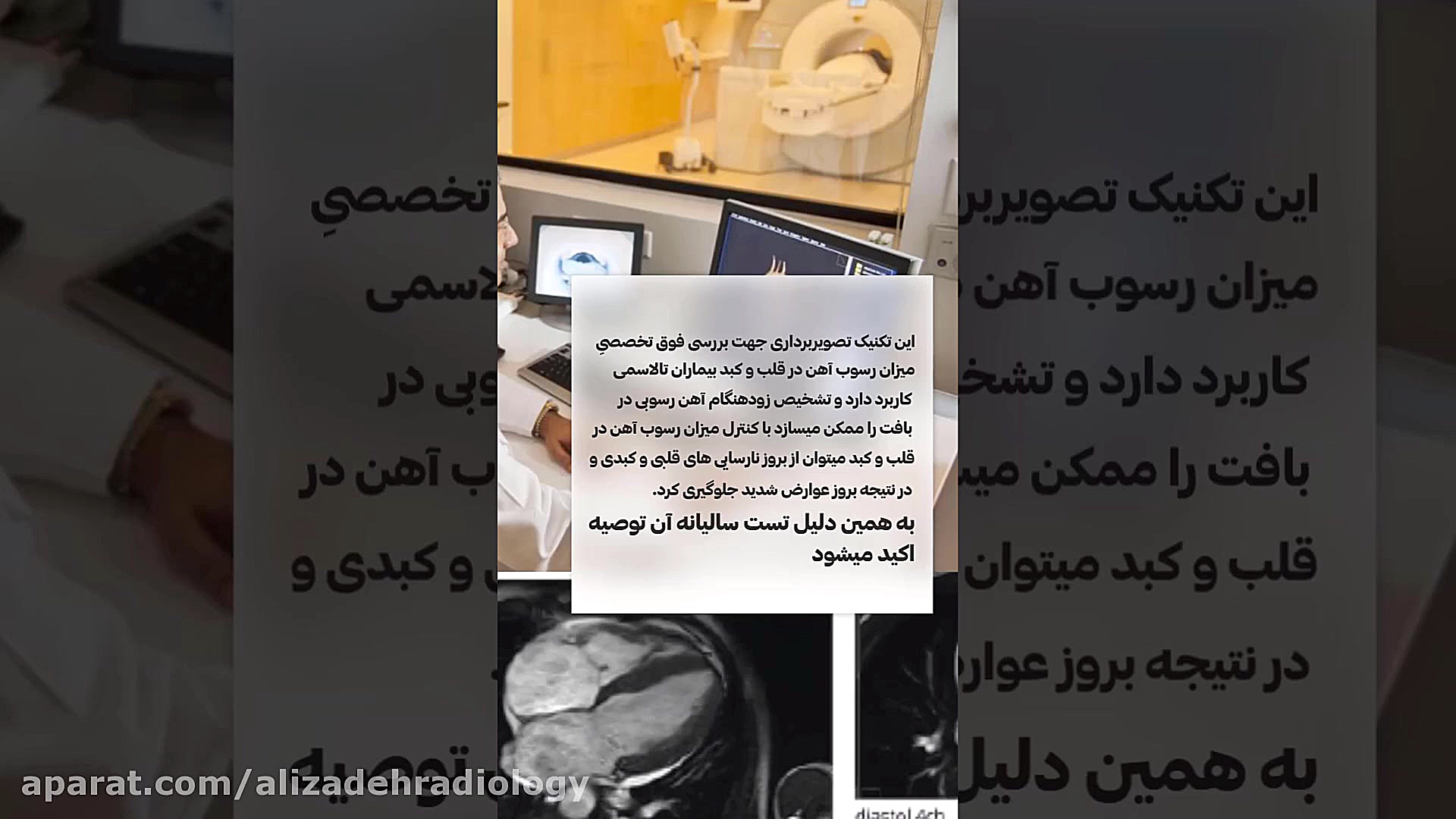 ام آر آی T2 star بیماران تالاسمی کاشت مو
