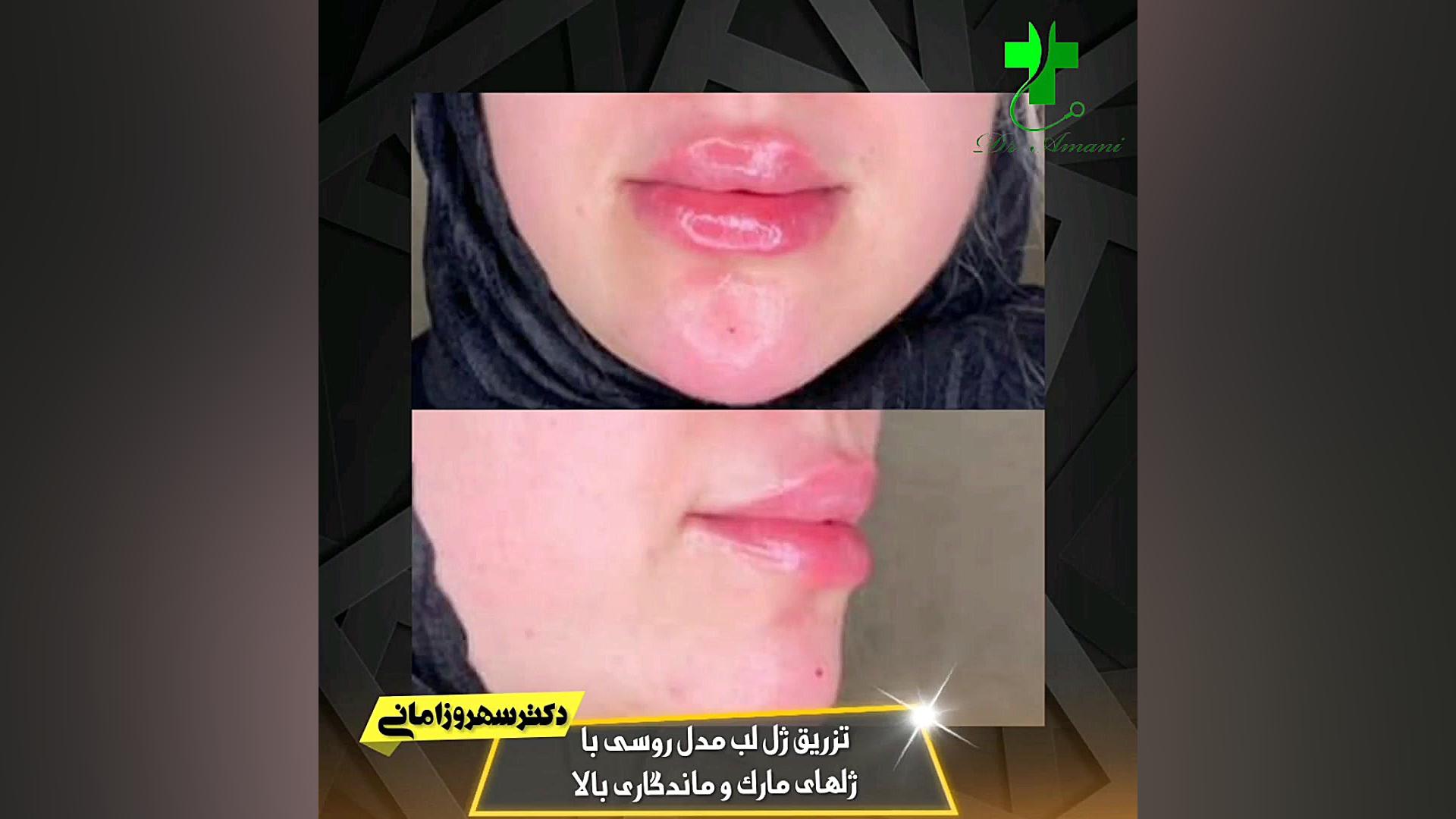 تزریق ژل لب مدل روسی سیستم ارزیابی هیستوترمیک