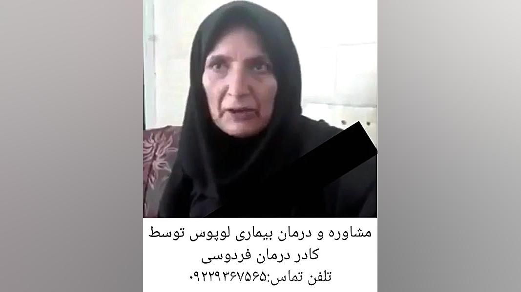 مصاحبه کادر درمان فردوسی با فرد درمان شده لوپوس کمند امیرسلیمانی
