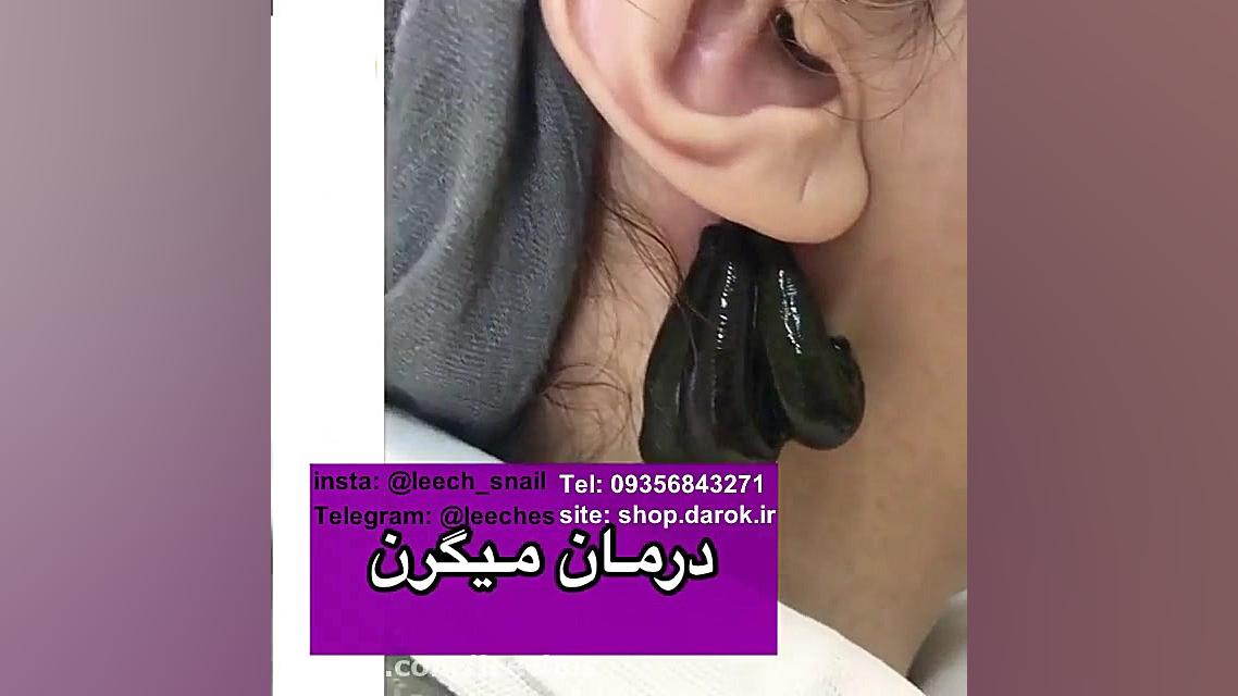 زالودرمانی پشت گوش برای میگرن بلیچینگ دندان
