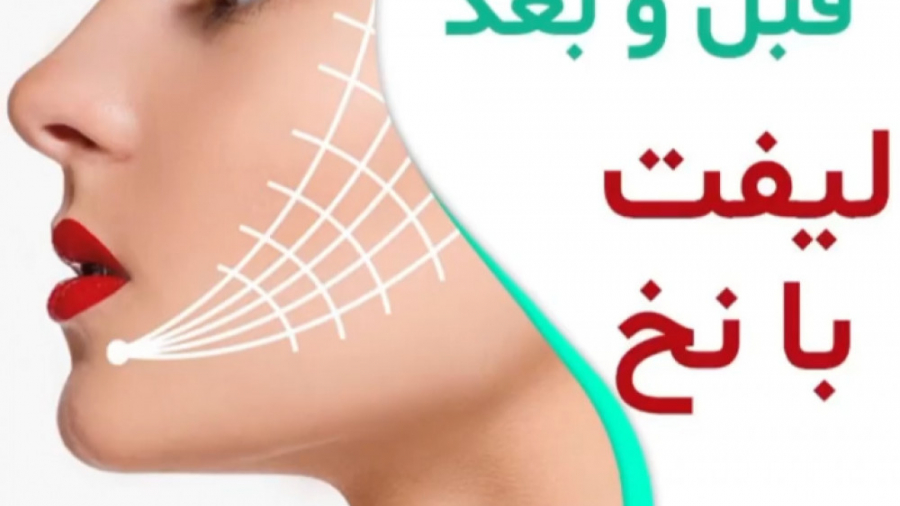 قبل و بعد لیفت با نخ دکتر سار ا لطفی