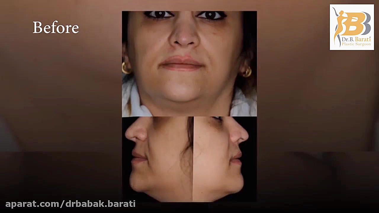 فرایند تزریق چربی به صورت به طور سرپایی برداشتن خال