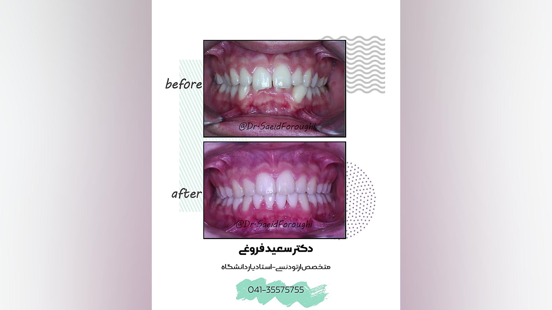 درمان بینظمی شدید دندانهای فک پایین (کراودینگ)، دکتر سعید فروغی متخصص ارتودنسی