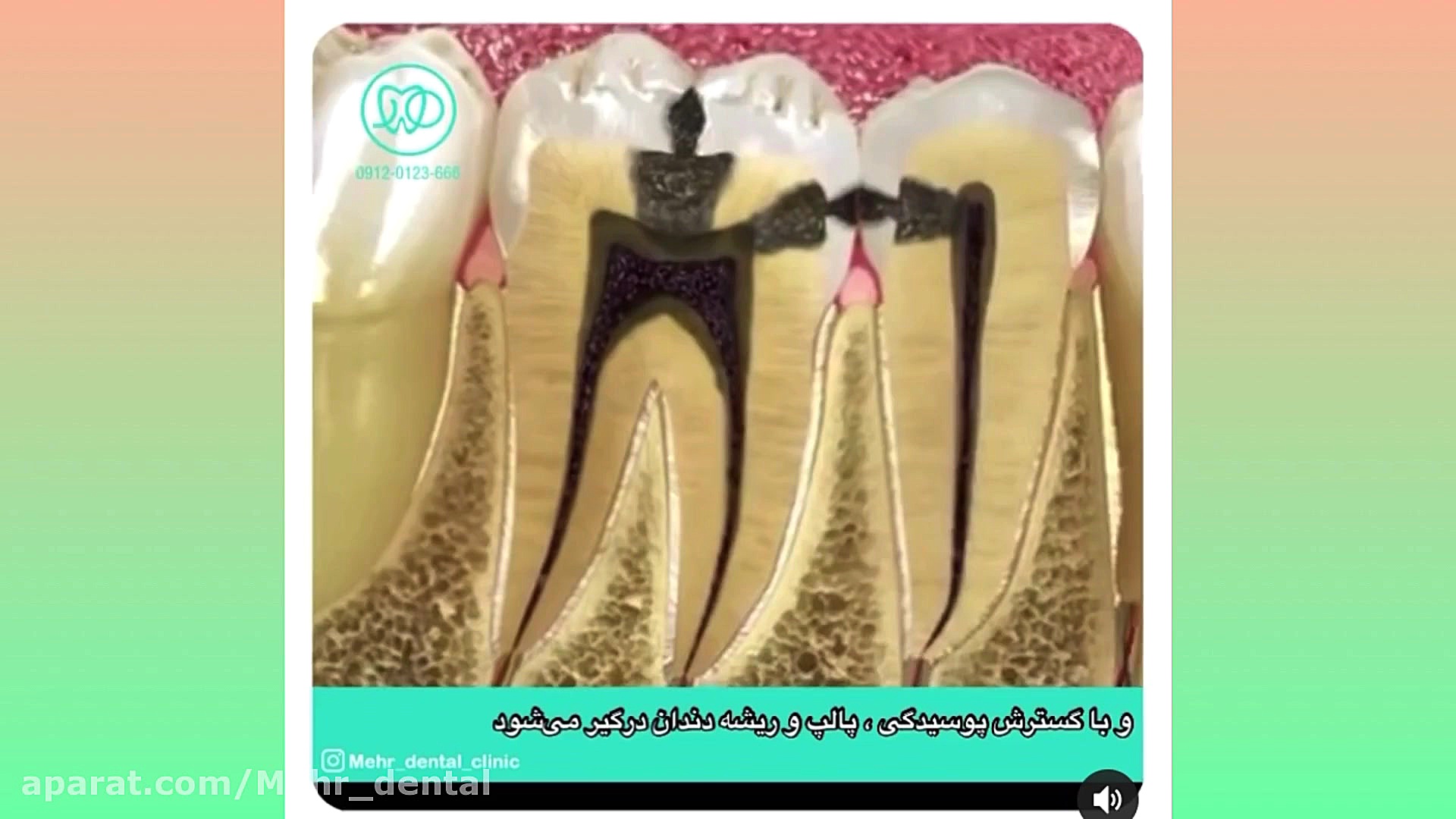 کلینیک دندانپزشکی مهر (mehr_dental_clinic) عصب کشی و روکش دندان Southern Blot