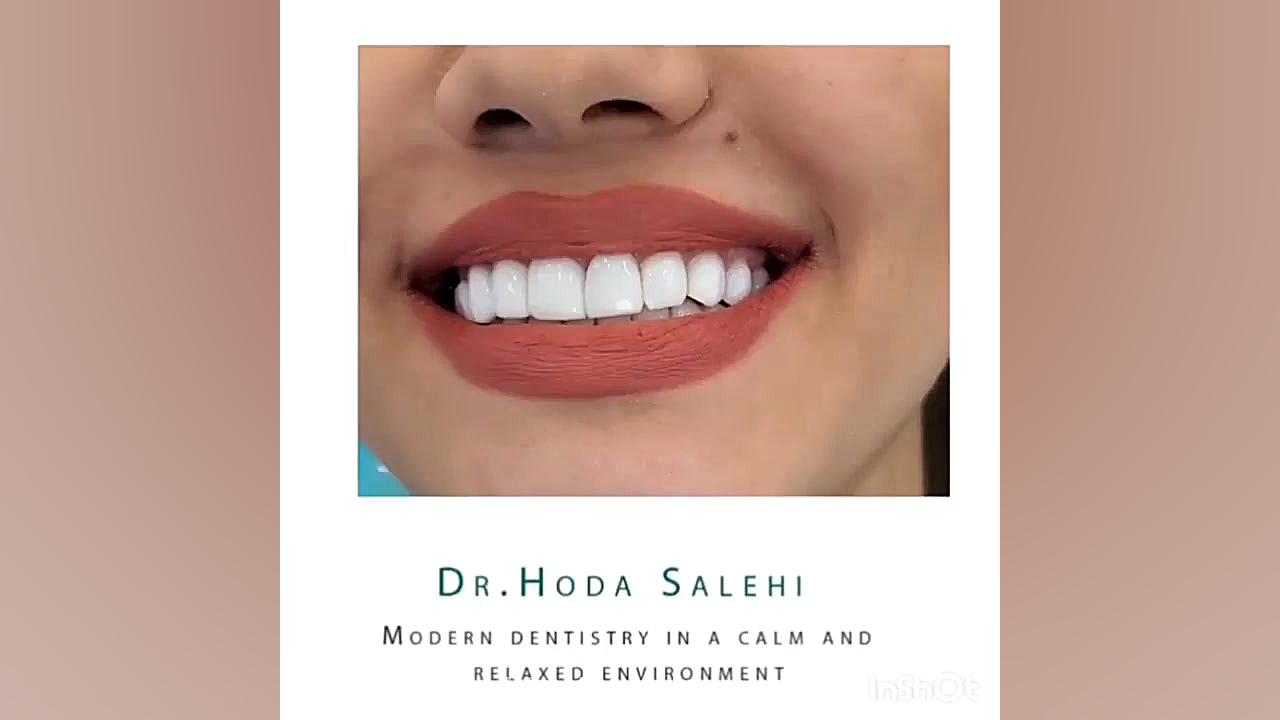 ونیر کامپوزیت در اصفهان دکتر هدی صالحی| دندانپزشک زیبایی در اصفهان