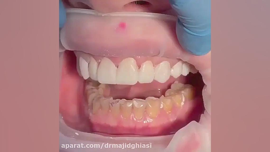 اصلاح طرح لبخند با درمانهای ترکیبی دکترمجیدقیاسی