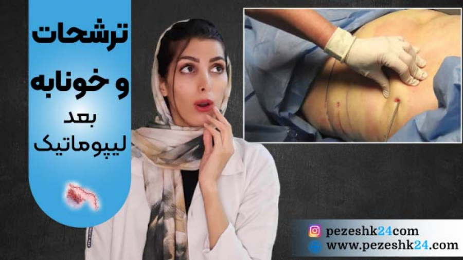 تخلیه خونابه بعد از لیپوماتیک ، آیا ترشح خونابه بعد از لیپوماتیک خطرناک است؟ آزمون ایمونوفیکساسیون