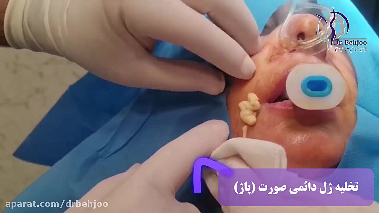 تخلیه ژل پاژ دکتر شاهین بهجو - فوق تخصص جراحی پلاستیک