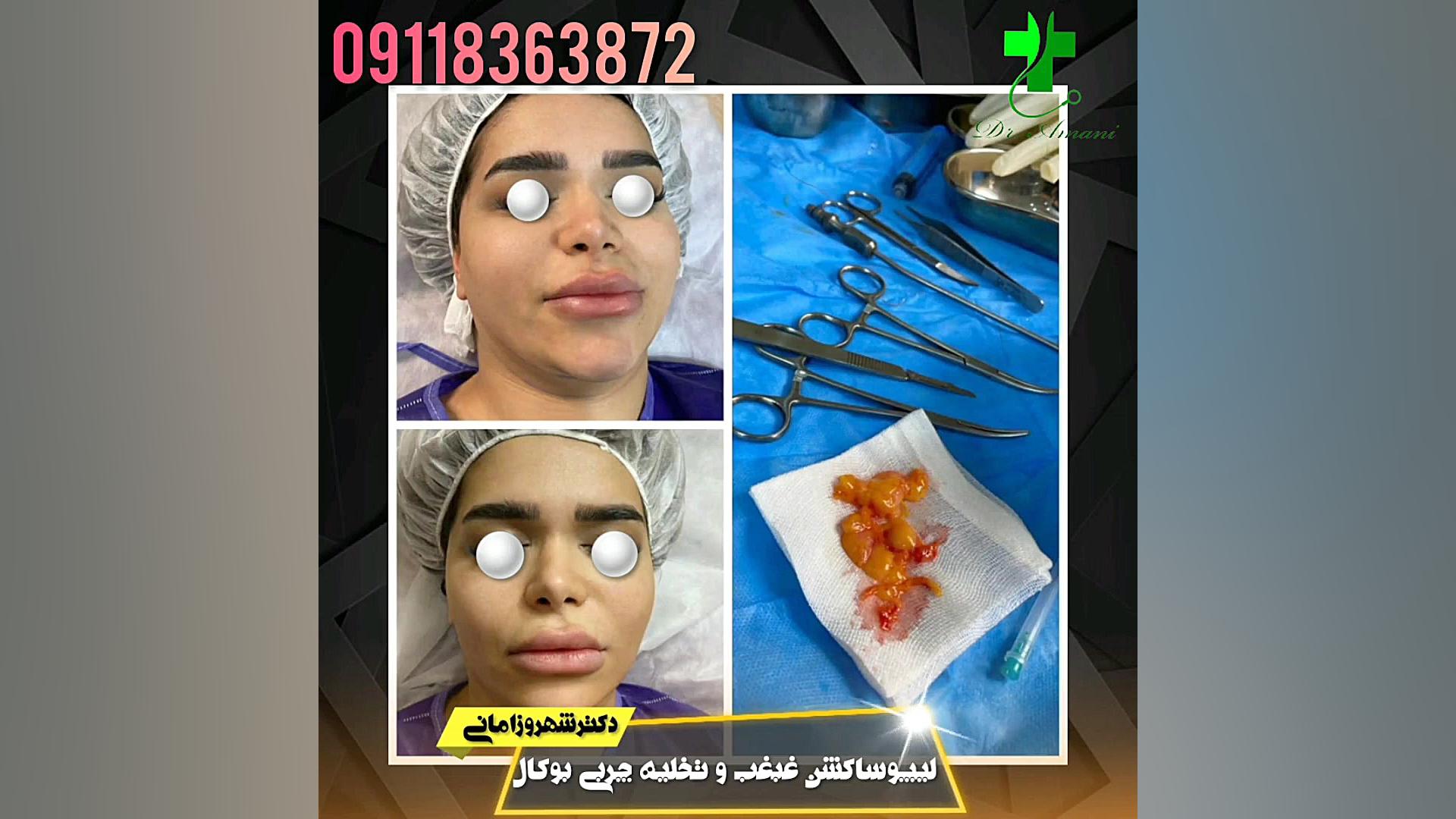 لیپوساکشن غبغب و تخلیه چربی بوکال دکترشهروزامانی در رشت لباس اگزواسکلتون پزشکی