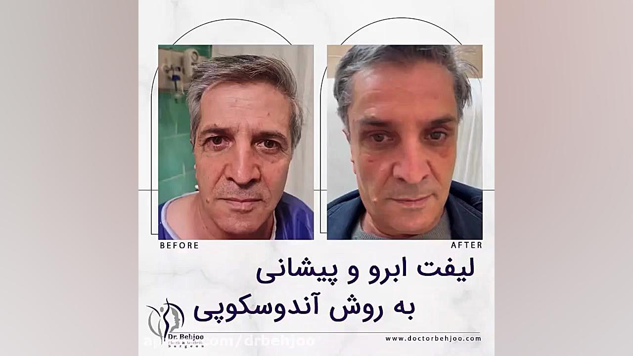 لیفت ابرو و پیشانی به روش اندوسکوپیک سیستم نانواینژکتور