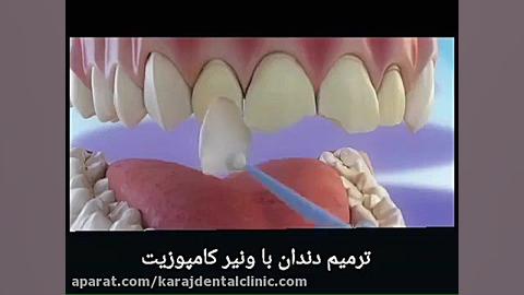 ترمیم دندان با ونیر کامپوزیت پوشش زخم هیدروکلوییدی