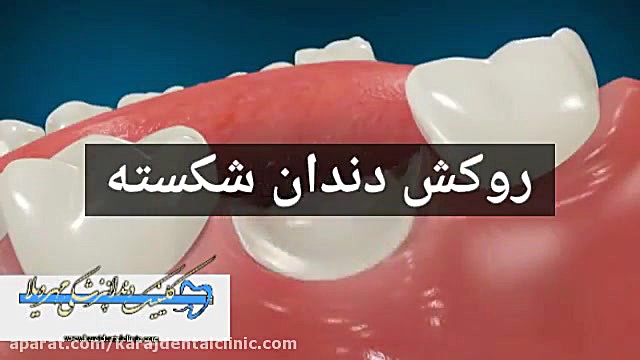 روکش دندان شکسته | کلینیک دندانپزشکی مهرویلا کرج ربات میکرونانو جراحی