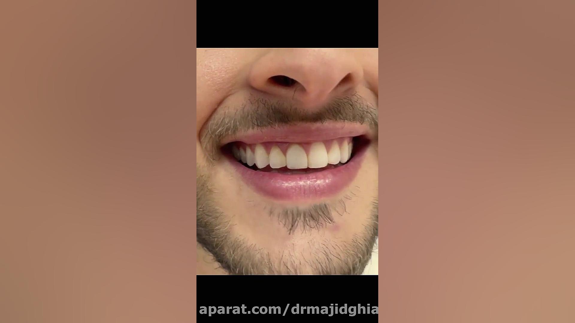 اصلاح طرح لبخند دکترمجیدقیاسی