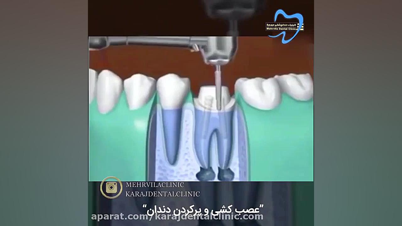عصب کشی و پر کردن دندان پاکسازی پوست