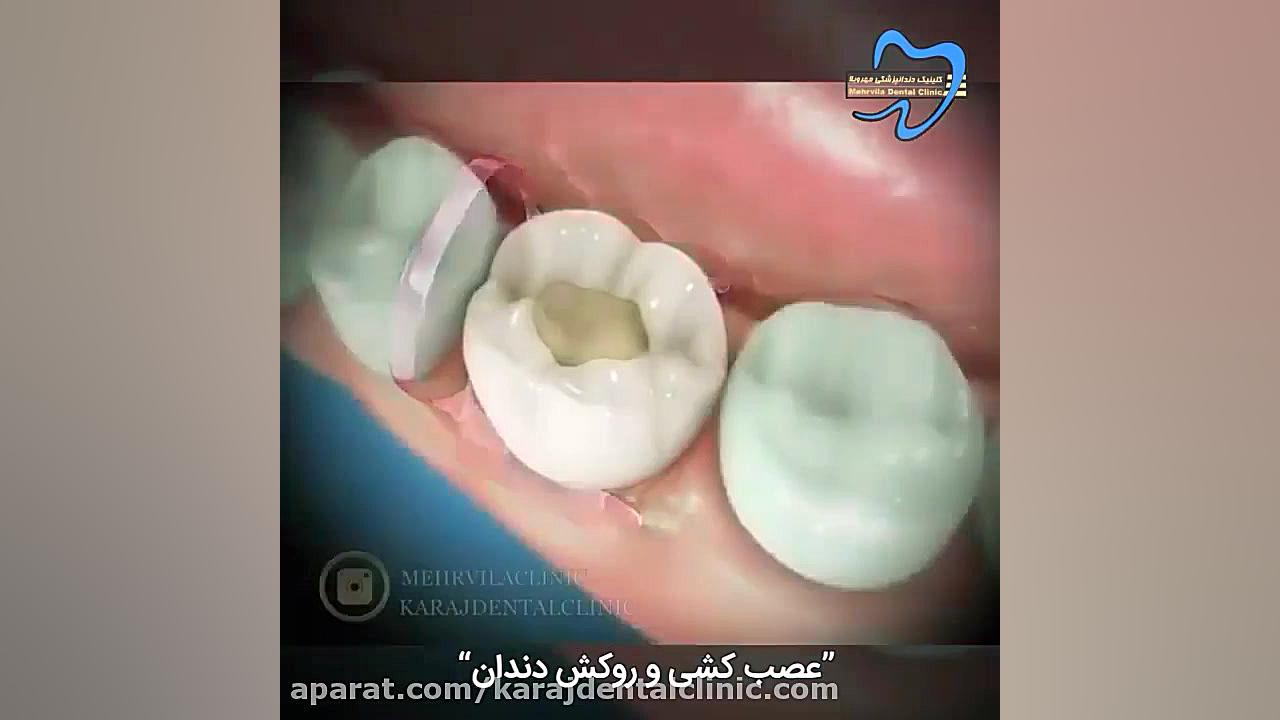 عصب کشی و روکش دندان تست لوسمی باقی‌مانده