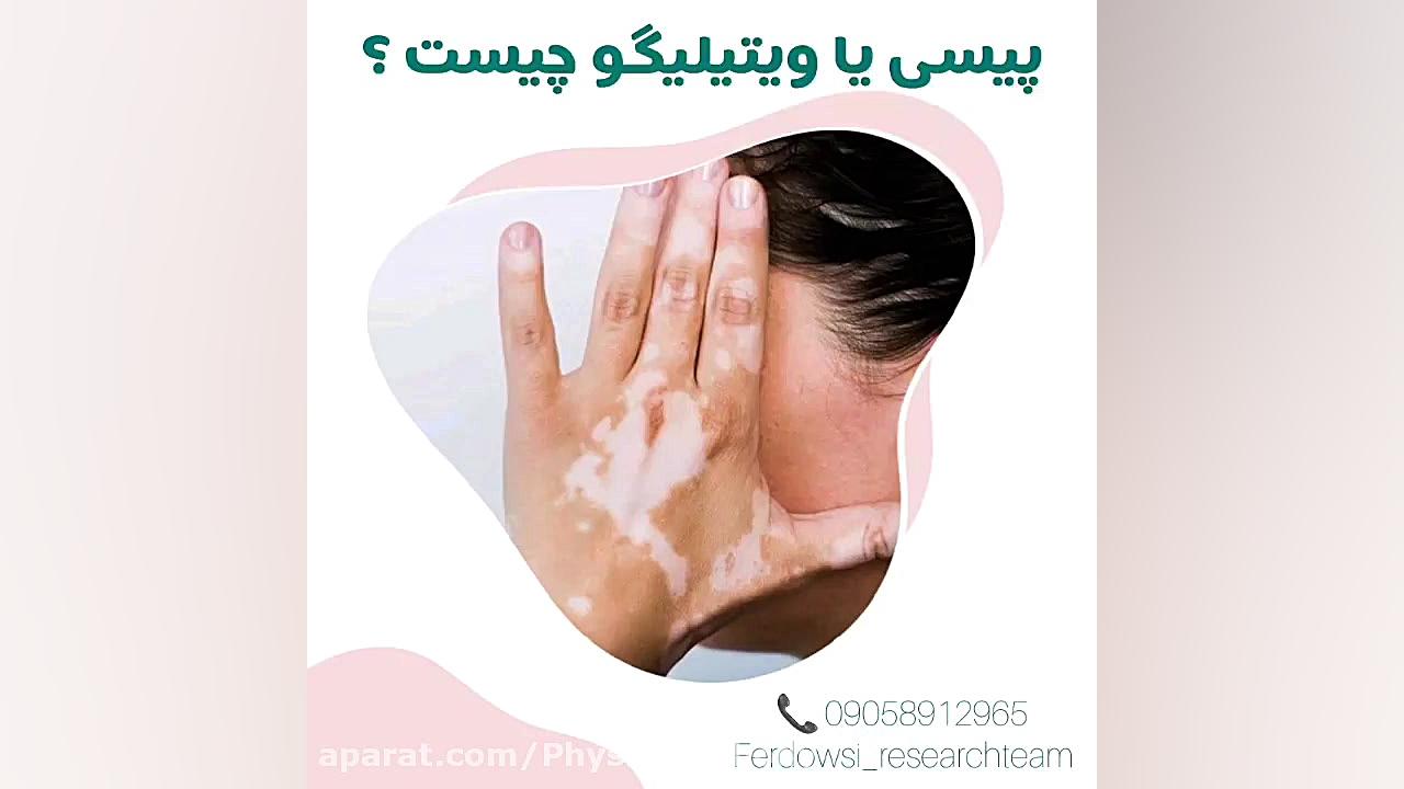 بیماری ویتیلیگو یا لکه های سفید پوست چگونه درمان میشود؟ گیمر