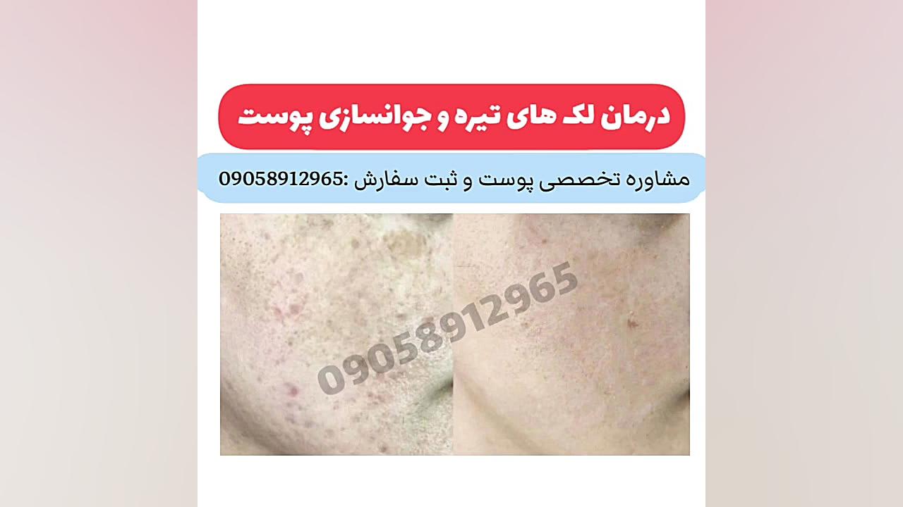 درمان لک های تیره پوست و روشن کننده پوست کامپوزیت ونیر