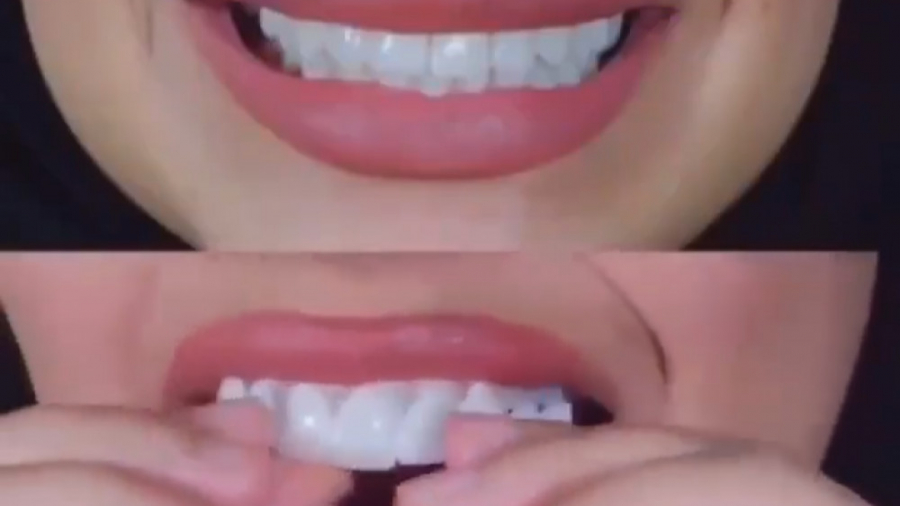 لمینت متحرک دندان Snap On Smile RF Test