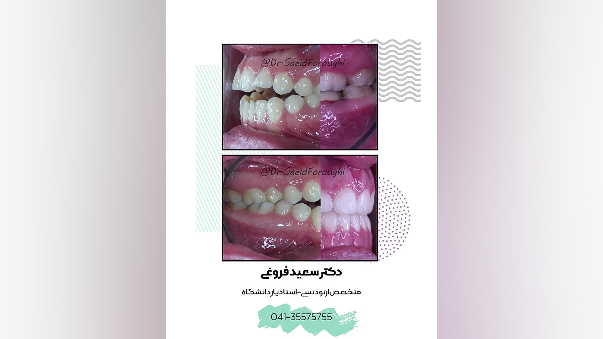 درمان عدم همپوشانی قابل توجه دندانهای قدامی (اپن بایت) دکتر سعید فروغی متخصص ارتودنسی