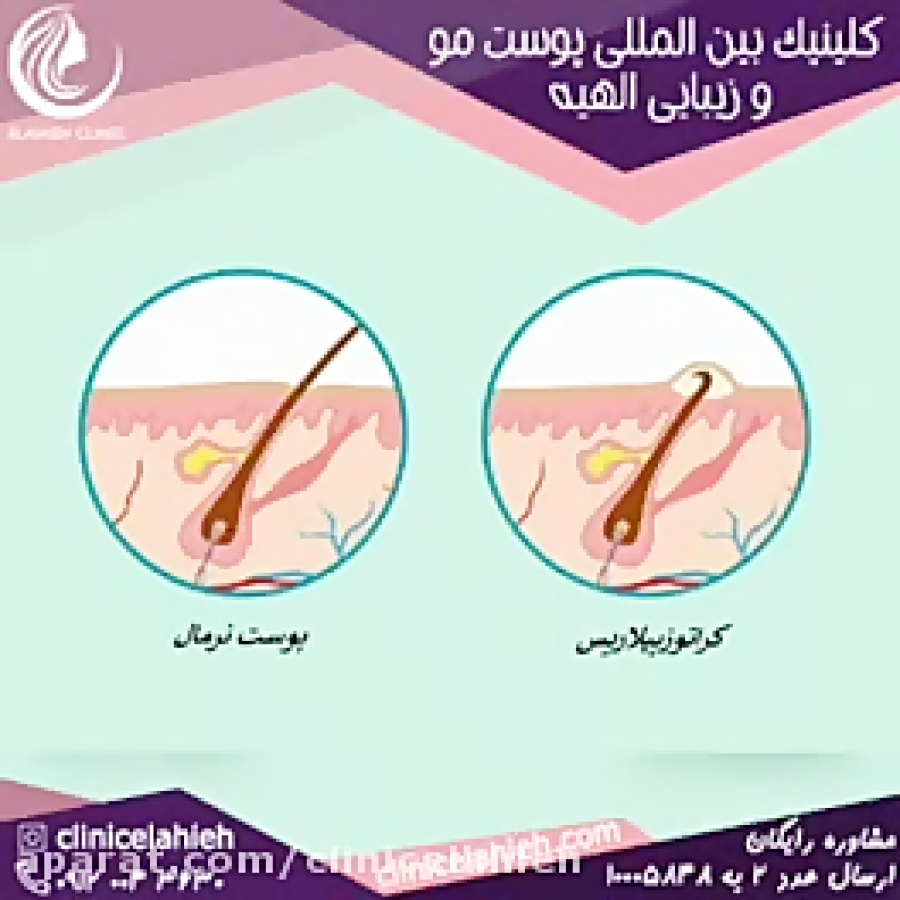 روش های درمان کراتوزیس، همان بیماری پوست مرغی